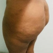 melaninchunk